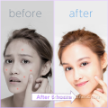 Shangyang Mighty e Invisible Acne Patch Patch de espinha de acne personalizada para espinhas